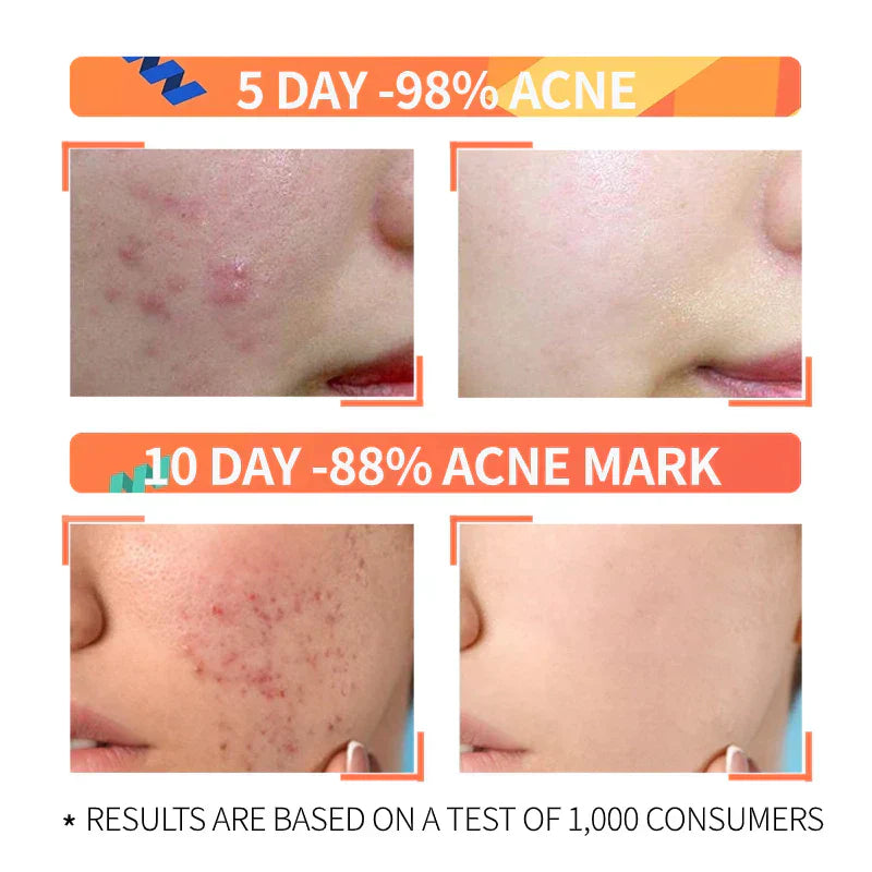 Buy Ordinary Niacinamide Serum Get Hyaluronic acid Serum Free 🌟✨in just 1599